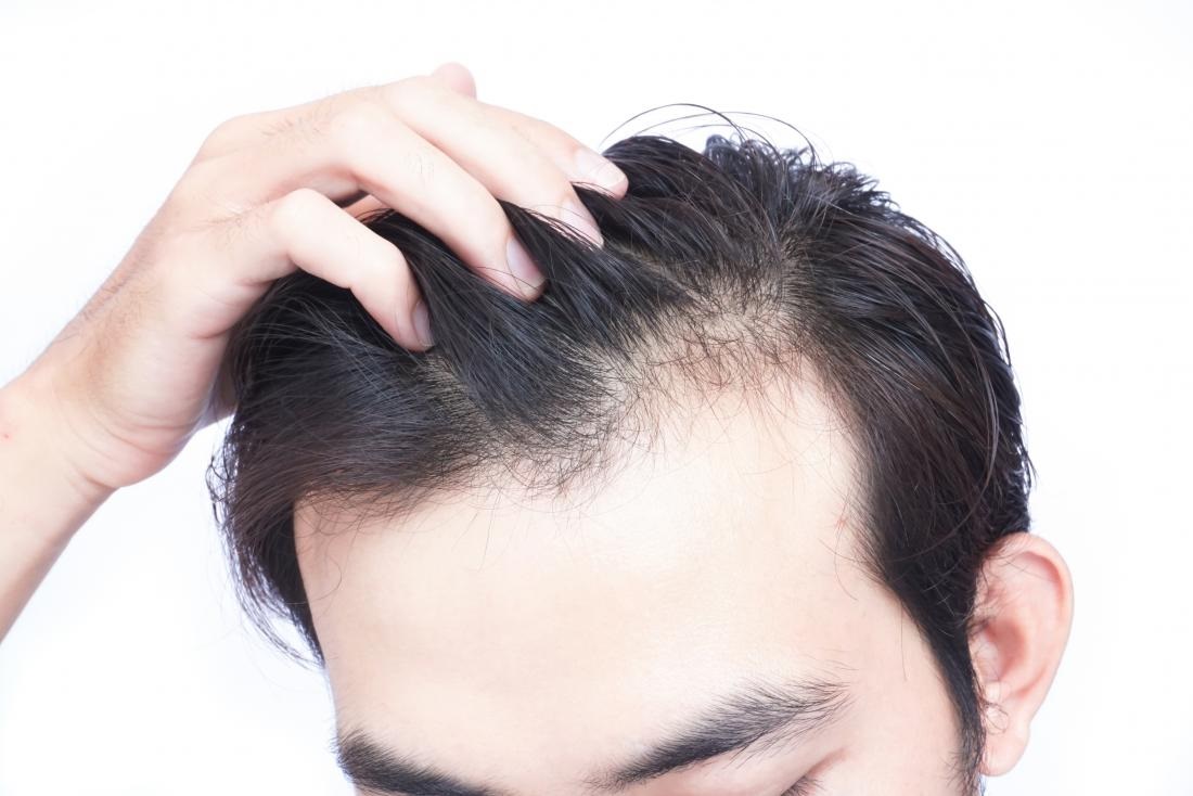 How Do I Stop Baldness at Age 20?